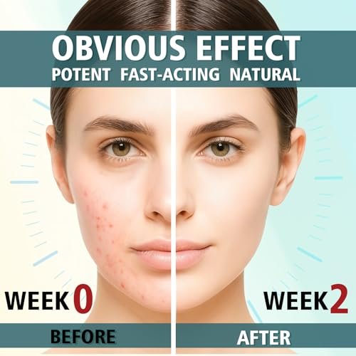 Acne Treatment Cream for Face & Body – Gentle Daily Moisturizer for Oily & Blemish-Prone Skin Avelisse