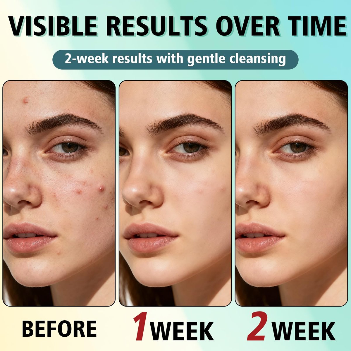 Acne Treatment Cream for Face & Body – Gentle Daily Moisturizer for Oily & Blemish-Prone Skin Avelisse