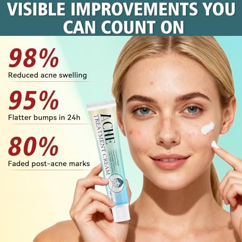 Acne Treatment Cream for Face & Body – Gentle Daily Moisturizer for Oily & Blemish-Prone Skin Avelisse