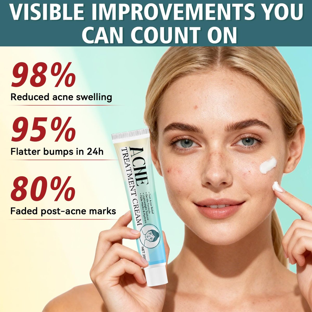 Acne Treatment Cream for Face & Body – Gentle Daily Moisturizer for Oily & Blemish-Prone Skin Avelisse