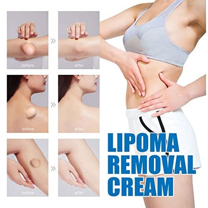 Lipoma Cream with Plant Extracts – Quick Effect Fat Lump Removal, Easy to Use, 20g/0.7oz Avelisse