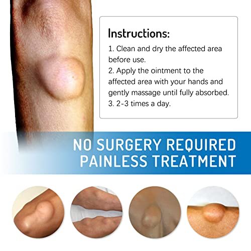 Lipoma Cream with Plant Extracts – Quick Effect Fat Lump Removal, Easy to Use, 20g/0.7oz Avelisse