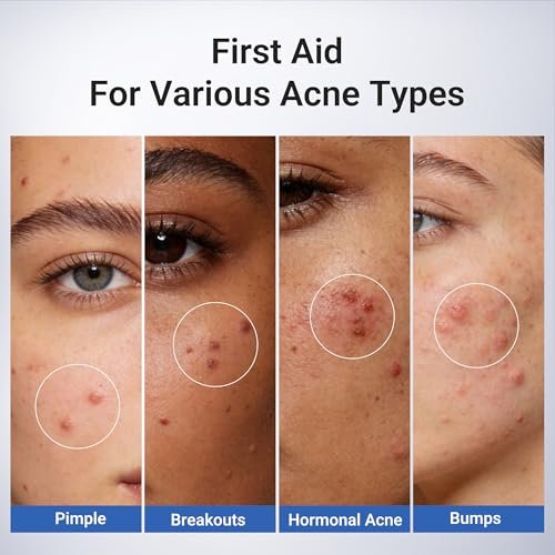 Dr.Leo 1.8% Salicylic Acid Spot Serum - Acne Drying Lotion for Sensitive Skin with Niacinamide, Fast Pimple Relief & Fades Marks, 0.34 fl oz Avelisse