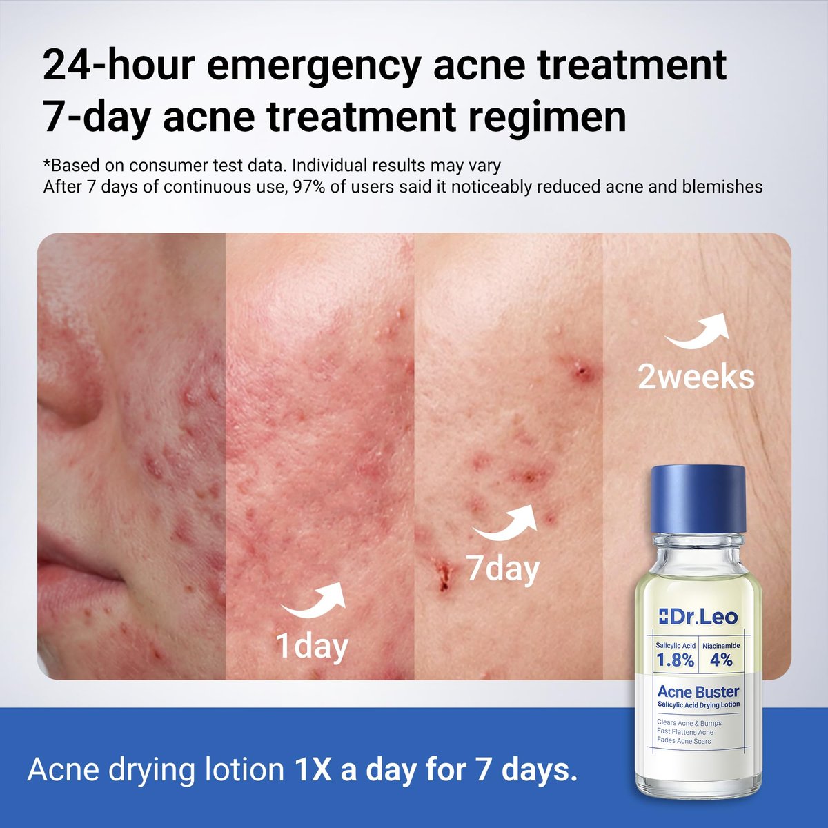 Dr.Leo 1.8% Salicylic Acid Spot Serum - Acne Drying Lotion for Sensitive Skin with Niacinamide, Fast Pimple Relief & Fades Marks, 0.34 fl oz Avelisse
