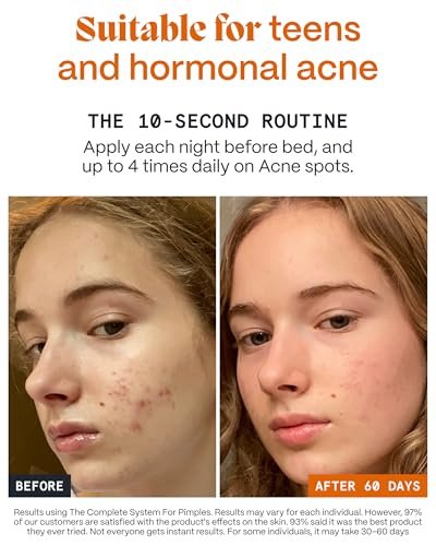 Norse Organics Pimple Stopper Night Balm – Acne Spot Treatment with Natural Bioactive Ingredients, Soothes Redness, Dermatologist Approved, 1 oz Avelisse