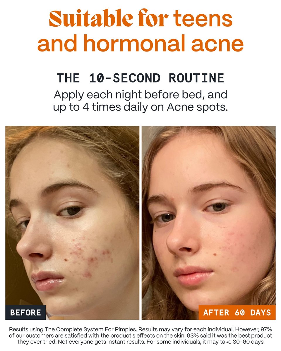 Norse Organics Pimple Stopper Night Balm – Acne Spot Treatment with Natural Bioactive Ingredients, Soothes Redness, Dermatologist Approved, 1 oz Avelisse