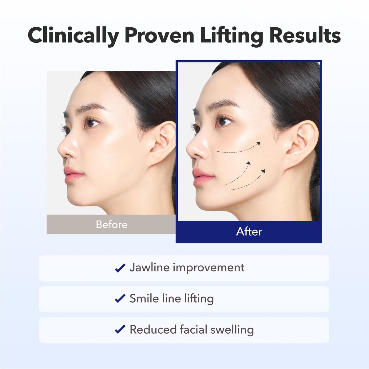 AVAJAR Chin Lifting Mask - Premium V Line Lifting Mask with Collagen, Hyaluronic Acid & Centella Asiatica for Jawline and Double Chin (5 Pack) Avelisse