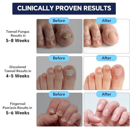Toenail Fungus Pen - 25% Undecylenic Acid - Nail Repair for Damaged, Ingrown & Discolored Nails - 4-Pack Twist Pen - görsel 5
