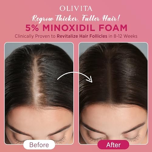 5% Minoxidil Foam for Women Hair Growth | Extra Strength Hair Regrowth Treatment – Revitalize Hair Follicles & Regrow Thicker, Fuller Hair – Hair Loss Solution (2-Pack) Avelisse