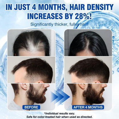 Redyuss 5% Minoxidil Hair Growth Spray Serum with Biotin for Men and Women – 3 Bottles of 2oz, Thicker, Fuller, Healthier Hair Avelisse