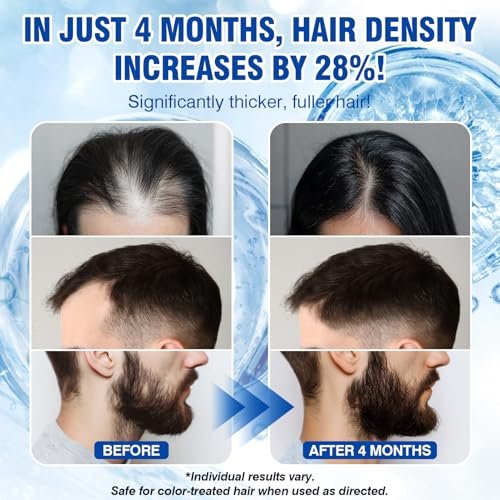 Redyuss 5% Minoxidil Hair Growth Spray Serum with Biotin for Men and Women – 3 Bottles of 2oz, Thicker, Fuller, Healthier Hair Avelisse