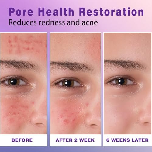 14% Azelaic Acid Acne Cream – Redness Relief & Clarifying Face Moisturizer for Acne-Prone Skin, Calms Pimples & Soothes Irritation, 1 oz - görsel 10