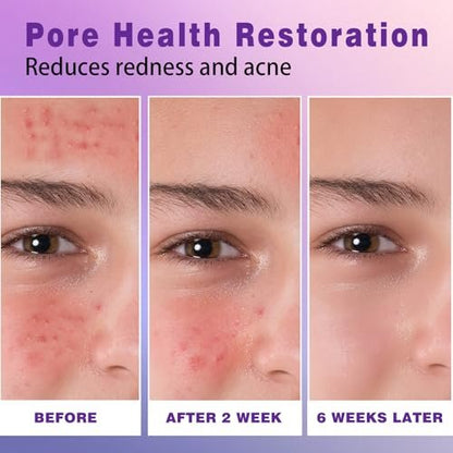 14% Azelaic Acid Acne Cream – Redness Relief & Clarifying Face Moisturizer for Acne-Prone Skin, Calms Pimples & Soothes Irritation, 1 oz