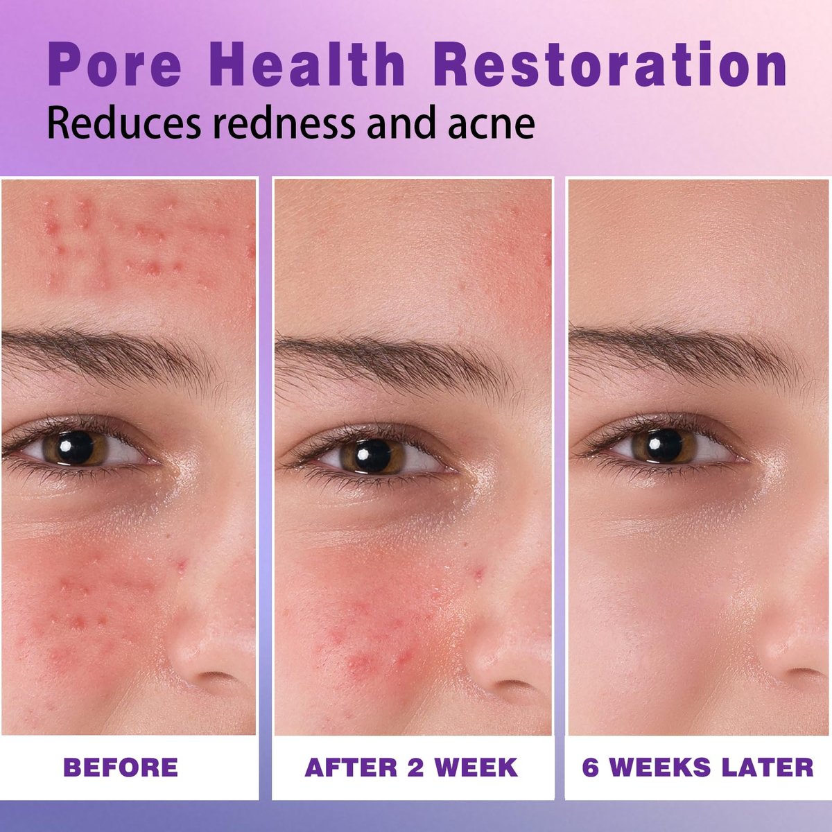 14% Azelaic Acid Acne Cream – Redness Relief & Clarifying Face Moisturizer for Acne-Prone Skin, Calms Pimples & Soothes Irritation, 1 oz - görsel 9
