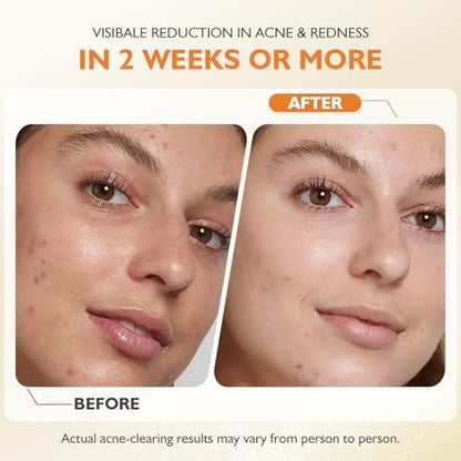 elesysy Organics Acne Killer Day Balm 2.0 – Natural Botanical Acne Treatment for Face, Body & Back | Reduces Pimples, Blackheads & Redness | Balancing, Hydrating & Non-Comedogenic Avelisse