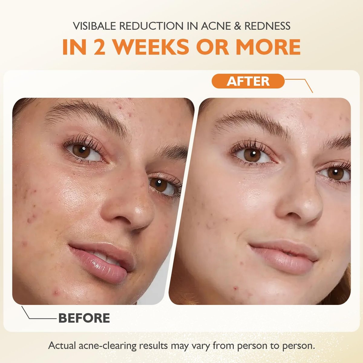 elesysy Organics Acne Killer Day Balm 2.0 – Natural Botanical Acne Treatment for Face, Body & Back | Reduces Pimples, Blackheads & Redness | Balancing, Hydrating & Non-Comedogenic Avelisse