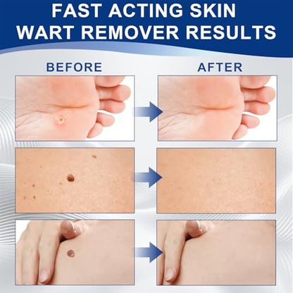 Befada Skin Tag Remover for Face & Body – Fast Acting Wart Remover Serum with Precision Dropper, Gentle Formula, Travel Size (0.33 FL OZ) Avelisse