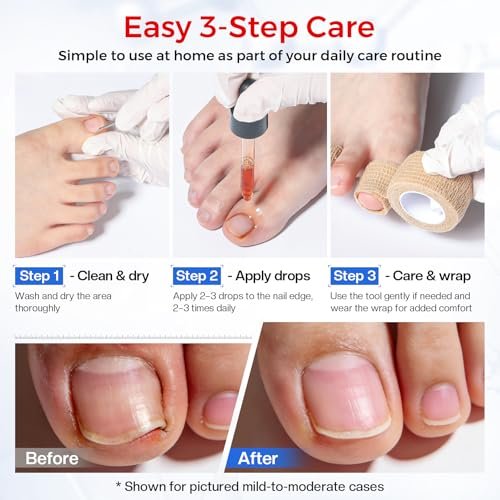 Glamonade Ingrown Toenail Relief Kit: Professional At-Home Ingrown Toenail Softening Drops with Lifter & Self-Adhesive Bandage for Mild Curved Toenails, 30ml Avelisse