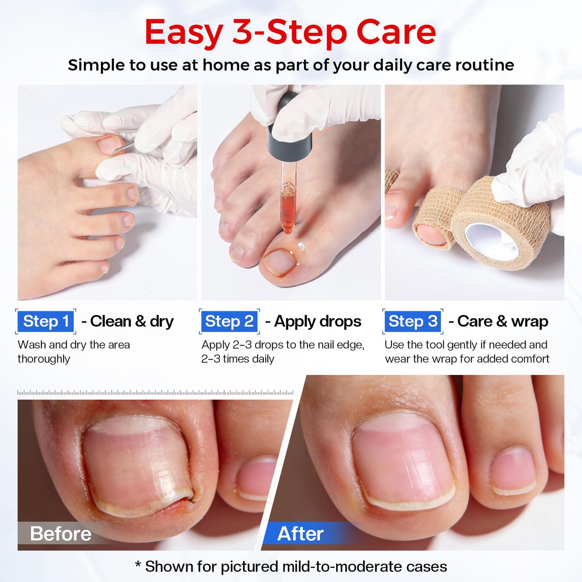 Glamonade Ingrown Toenail Relief Kit: Professional At-Home Ingrown Toenail Softening Drops with Lifter & Self-Adhesive Bandage for Mild Curved Toenails, 30ml Avelisse