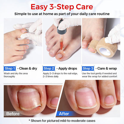 Glamonade Ingrown Toenail Relief Kit: Professional At-Home Ingrown Toenail Softening Drops with Lifter & Self-Adhesive Bandage for Mild Curved Toenails, 30ml Avelisse