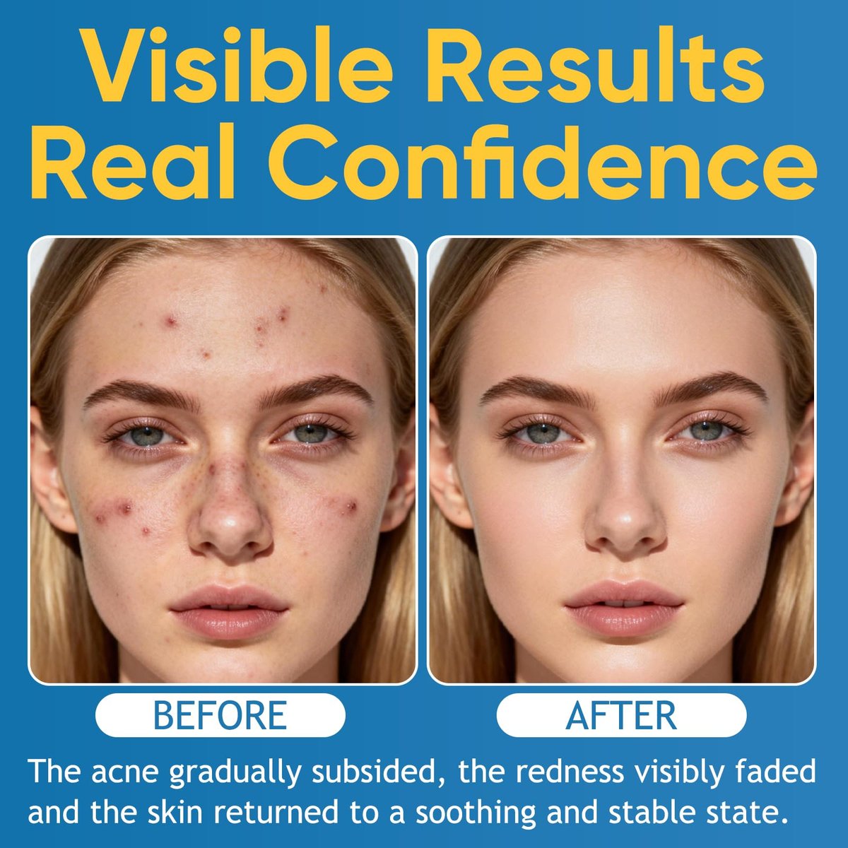 Acne & Redness Killer 2-Pack – Organic Acne Balm for All Skin Types Avelisse