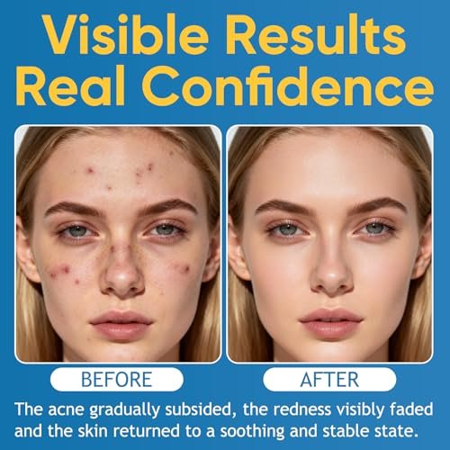 Acne & Redness Killer 2-Pack – Organic Acne Balm for All Skin Types Avelisse