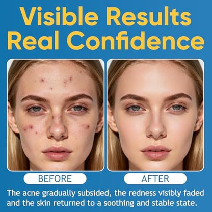 Acne & Redness Killer 2-Pack – Organic Acne Balm for All Skin Types Avelisse