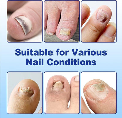 Nail Patches for Toenails - 2 Pack Toenail Stickers, 8-Hour Overnight Nail Patches, Fits Large & Small Nails, 42 Count (Blue A)