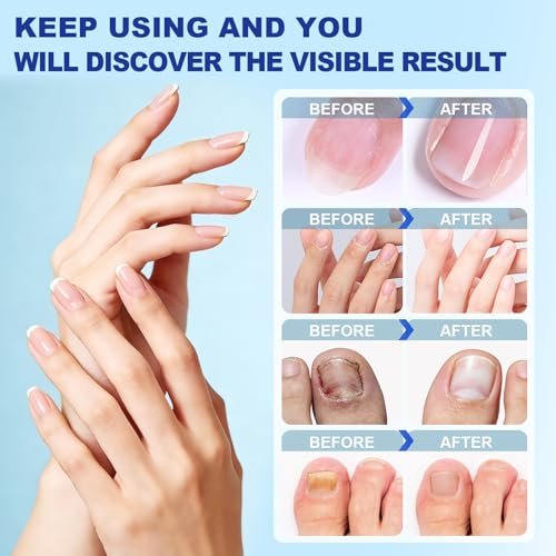 Nail Patches for Toenails - 2 Pack Toenail Stickers, 8-Hour Overnight Nail Patches, Fits Large & Small Nails, 42 Count (Blue A) - görsel 4