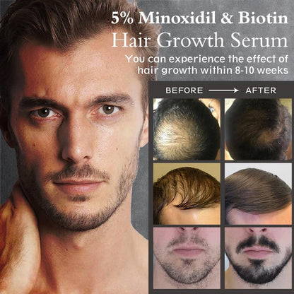 Ruahouine Hair Growth Treatment – 5% Minoxidil & Biotin Serum for Thicker, Longer Hair – Prevents Hair Loss & Thinning for Men and Women – 2.11 fl oz