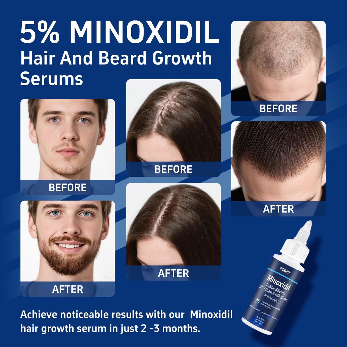 6 Pack 5% Minoxidil with Biotin Hair Growth Treatment for Men and Women, Thicker Fuller Hair & Beard Serum, 12 fl oz (6 Month Supply) Avelisse