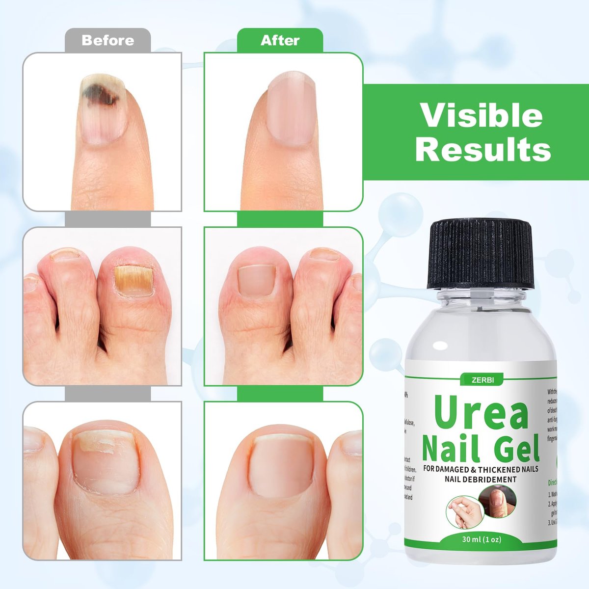 ZERBI 47% Urea Nail Gel – Medical-Grade Softening for Thick Toenails & Cracked Heel Calluses, Quick-Drying Formula Restores Nail Strength & Clarity, 1 Fl Oz Avelisse