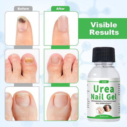 ZERBI 47% Urea Nail Gel – Medical-Grade Softening for Thick Toenails & Cracked Heel Calluses, Quick-Drying Formula Restores Nail Strength & Clarity, 1 Fl Oz Avelisse