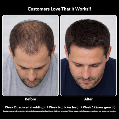 DHT Blocker for Men with Biotin 10000mcg - Saw Palmetto & MSM for Healthy Hair Growth - Vegan, Non-GMO, Gluten Free - 30 Servings - görsel 9
