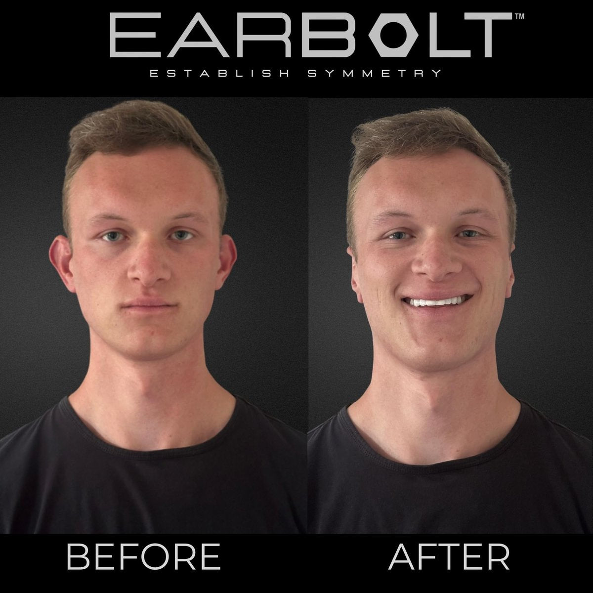 EARBOLT Ear Pinning Adhesives - Cosmetic Ear Correctors, Pack of 20 - Non-Surgical Ear Reshaping for Protruding Ears Avelisse