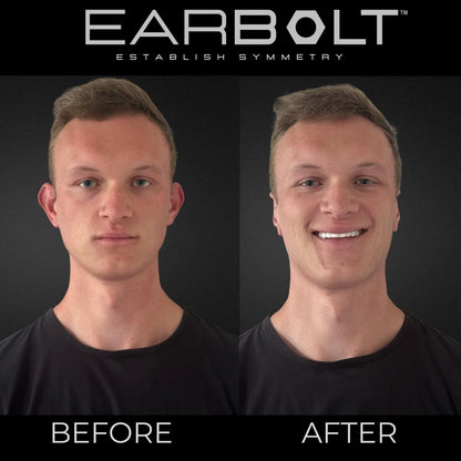 EARBOLT Ear Pinning Adhesives - Cosmetic Ear Correctors, Pack of 20 - Non-Surgical Ear Reshaping for Protruding Ears Avelisse