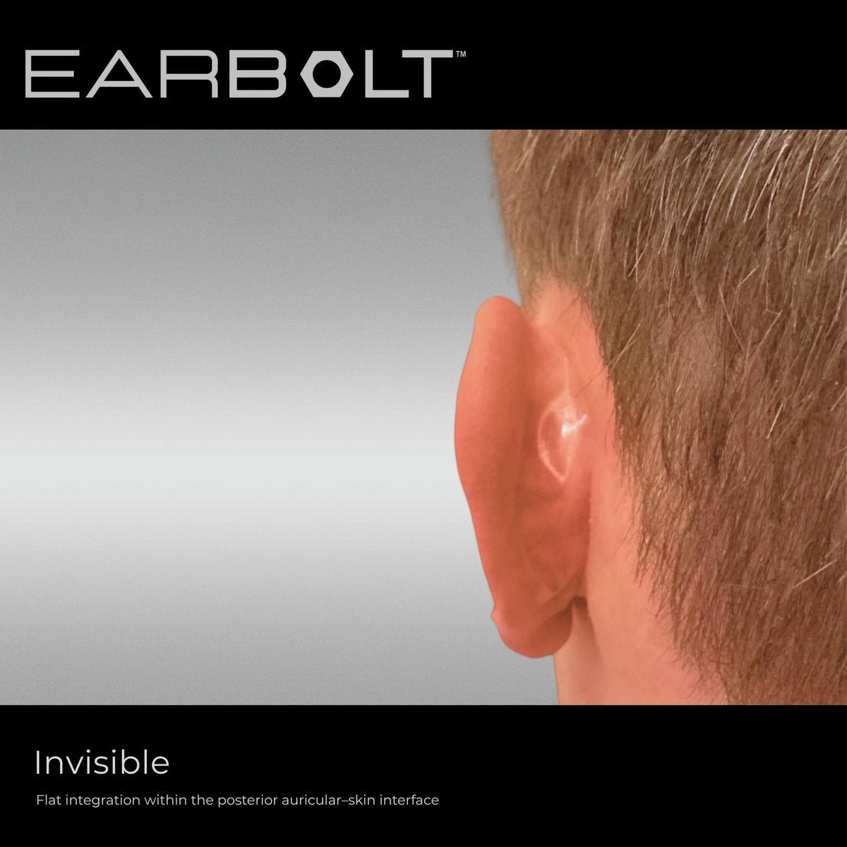 EARBOLT Ear Pinning Adhesives - Cosmetic Ear Correctors, Pack of 20 - Non-Surgical Ear Reshaping for Protruding Ears Avelisse