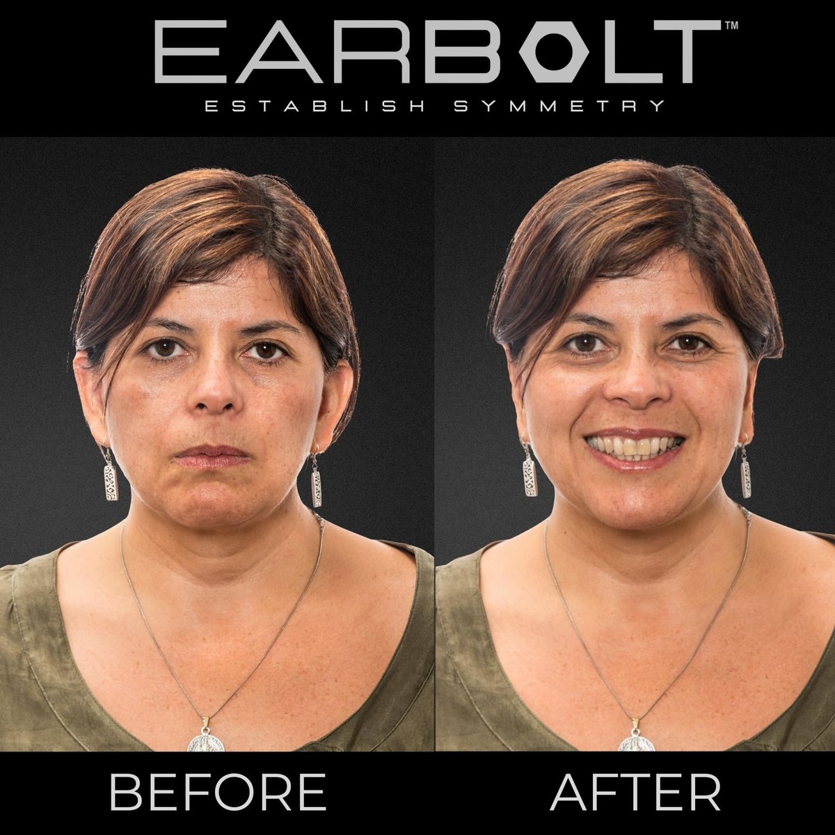 EARBOLT Ear Pinning Adhesives - Cosmetic Ear Correctors, Pack of 20 - Non-Surgical Ear Reshaping for Protruding Ears Avelisse