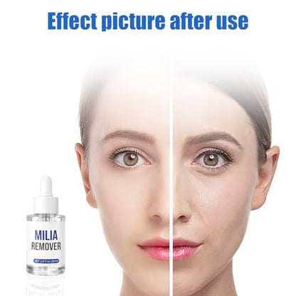 Milia Remover Treatment Serum with Salicylic Acid - Eye & Face Milia Spot Treatment, 1 Fl Oz Avelisse