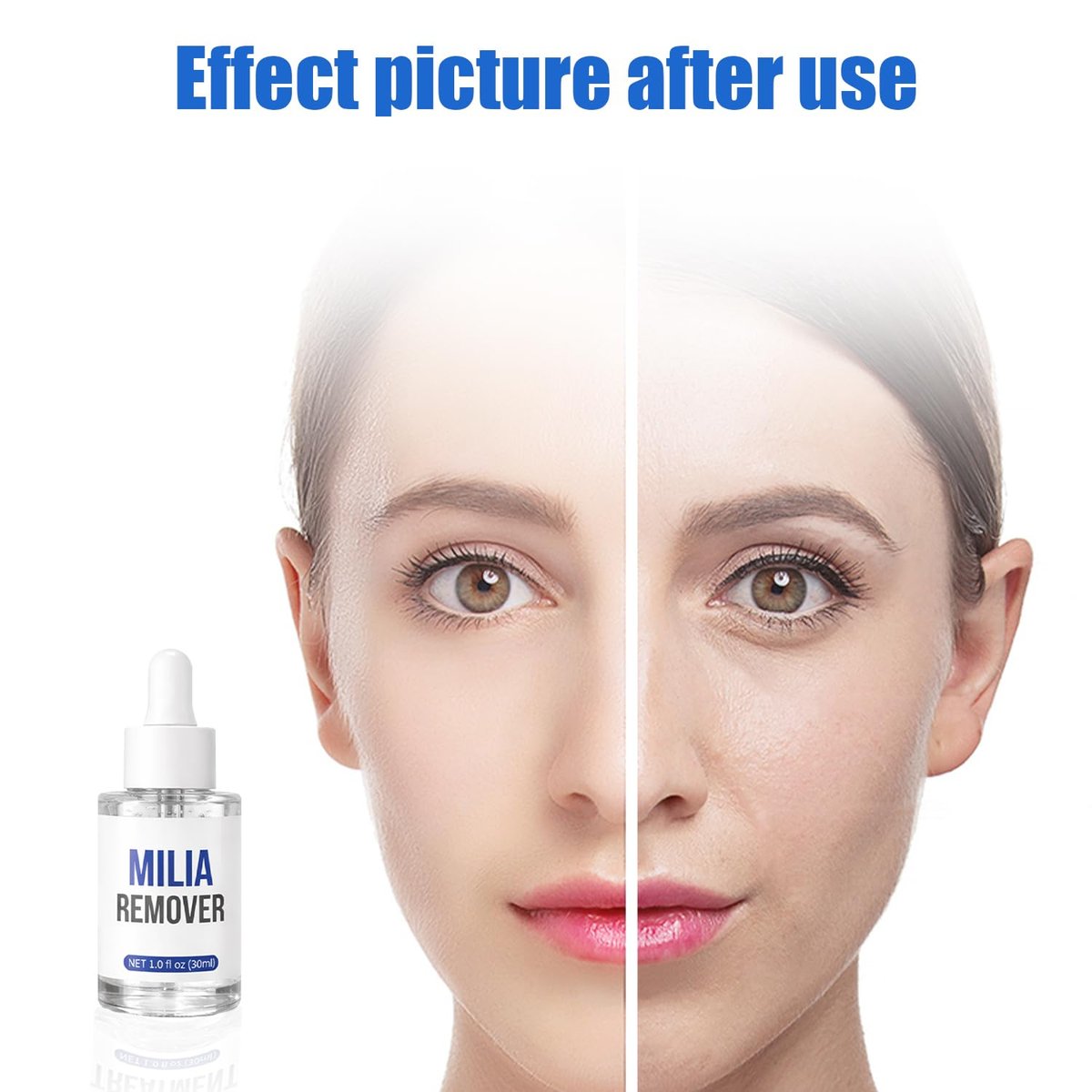 Milia Remover Treatment Serum with Salicylic Acid - Eye & Face Milia Spot Treatment, 1 Fl Oz Avelisse