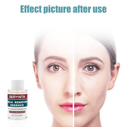 SERYNTH Milia Remover Serum with Salicylic Acid for Eyes and Face | 1 Fl Oz Avelisse