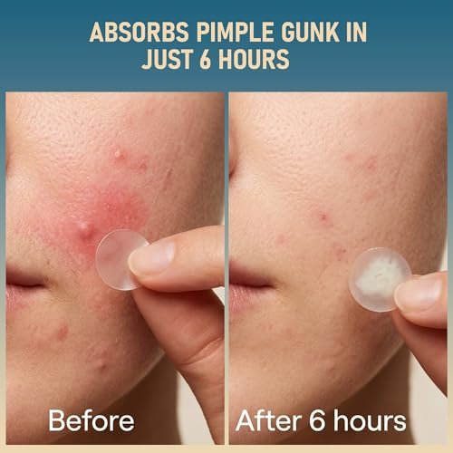 TKGOU Pimple Patches for Face - 1250 Counts 3 Size Acne Patches, Hydrocolloid Spot Stickers for All Skin Types - Invisible Zit Patches to Shrink Blemishes & Breakouts - görsel 8