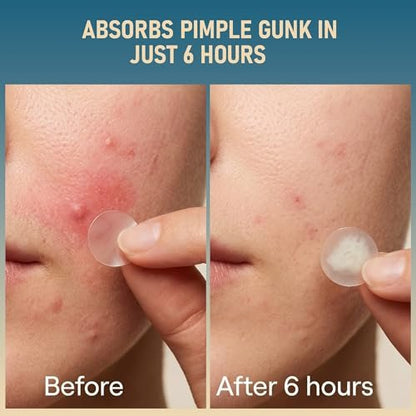 TKGOU Pimple Patches for Face - 1250 Counts 3 Size Acne Patches, Hydrocolloid Spot Stickers for All Skin Types - Invisible Zit Patches to Shrink Blemishes & Breakouts