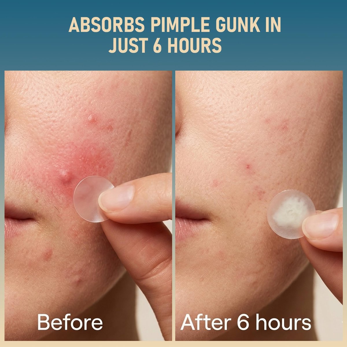 TKGOU Pimple Patches for Face - 1250 Counts 3 Size Acne Patches, Hydrocolloid Spot Stickers for All Skin Types - Invisible Zit Patches to Shrink Blemishes & Breakouts - görsel 7