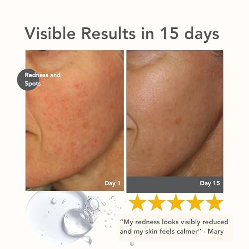 Riversol Rosacea Treatment for Face | Anti-Redness Serum for Sensitive Skin | Calming Redness Relief | Vitamin C & E | Anti-Aging Formula | Fragrance Free | Dermatologist Developed | Made in Canada Avelisse