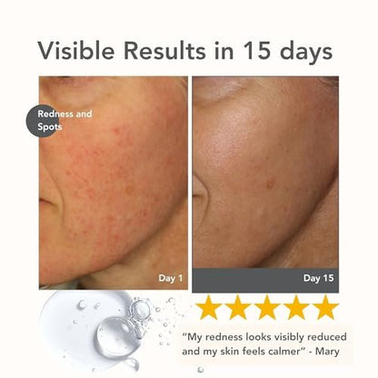 Riversol Rosacea Treatment for Face | Anti-Redness Serum for Sensitive Skin | Calming Redness Relief | Vitamin C & E | Anti-Aging Formula | Fragrance Free | Dermatologist Developed | Made in Canada Avelisse