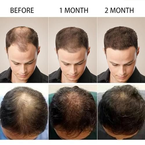 5% Minoxidil Hair Growth Scalp Massage Cream with Rosemary & Biotin - Professional Anti Hair Loss Treatment for Men & Women - görsel 7