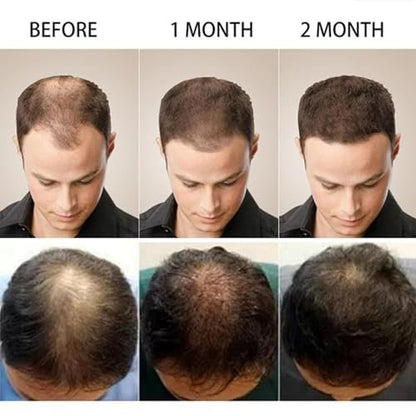 5% Minoxidil Hair Growth Scalp Massage Cream with Rosemary & Biotin - Professional Anti Hair Loss Treatment for Men & Women