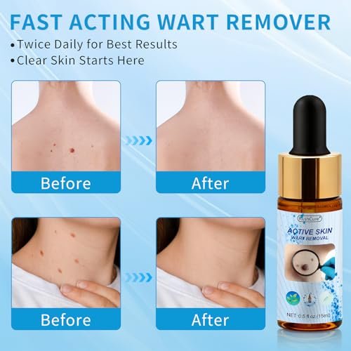 RushCure Skin Wart Remover with 17% Salicylic Acid - Fast Acting Mole Remover Serum for Plantar, Common & Flat Warts, Gentle Formula with Precision Dropper, Travel Size (0.5 Fl Oz) Avelisse