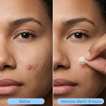 1250 Count Pimple Patches for Face - 3 Sizes (8mm, 10mm, 12mm) Hydrocolloid Acne Patches, Cute Round Acne Stickers, Covers Zits, Blemishes & Breakouts – Gentle on All Skin Types